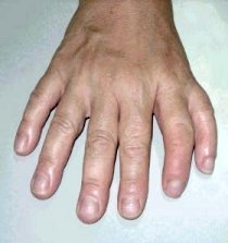 I10-10-polydactyly.jpg