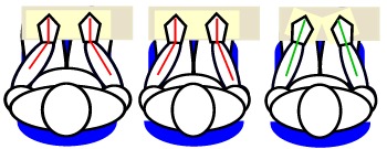RSI_ulnar_deviation.jpg